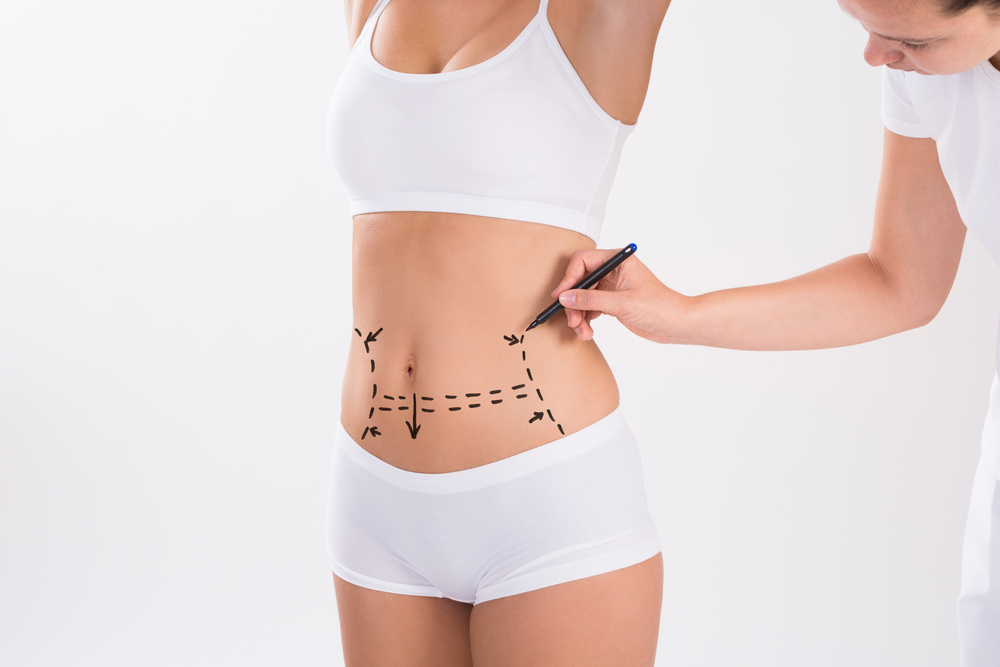 Marcações na barriga do paciente para realização de abdominoplastia